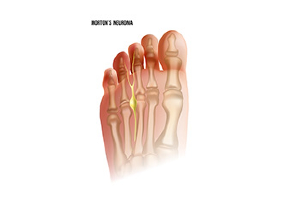 Understanding Morton’s Neuroma and Foot Nerve Pain