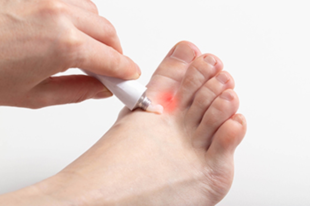 Understanding Athlete’s Foot and How It Is Treated