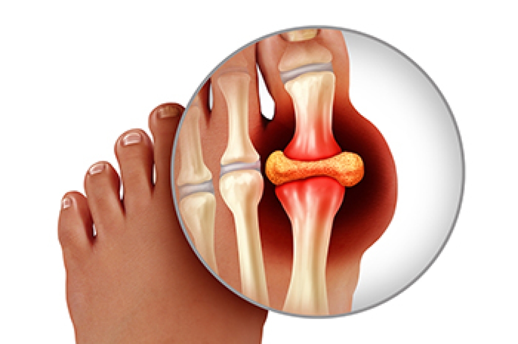 Gout and Its Effects on Foot Health