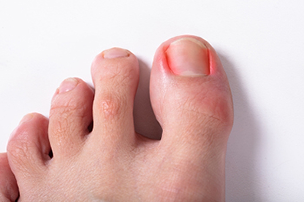 Ingrown Toenails and Foot Structure