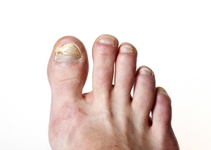 Understanding Fungal Infections of the Toenail