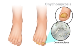 Treatment for Fungal Toenail Infections