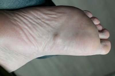 A Foot Condition Called Plantar Fibroma