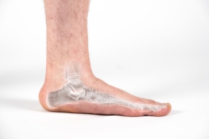 When to See a Podiatrist for Flat Feet