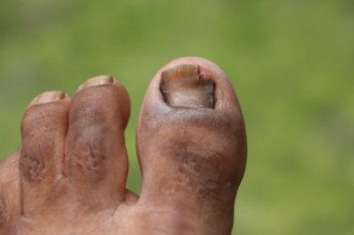 When Fungus Takes Over Your Toenail