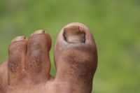 When Fungus Takes Over Your Toenail