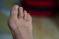 Characteristics of Hammertoe