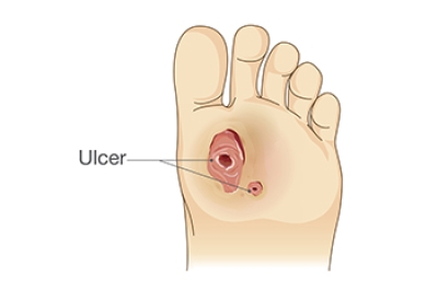 Caring for Diabetic Foot Ulcers